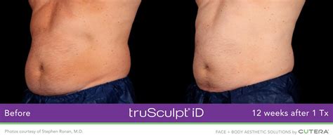 Trusculpt before and after pictures from past patients. . Trisculpt reviews